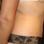 Tummy Tuck Before & After Patient #29642