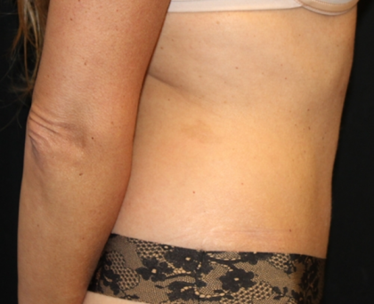 Tummy Tuck Before & After Patient #29642