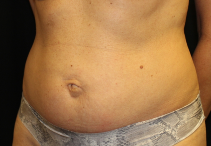 Tummy Tuck Before & After Patient #29642