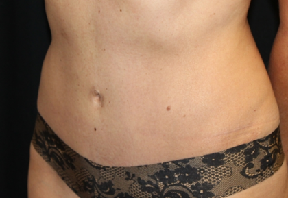 Tummy Tuck Before & After Patient #29642