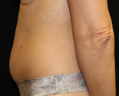 Tummy Tuck Before & After Patient #29642