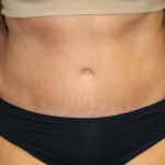 Tummy Tuck Before & After Patient #29819