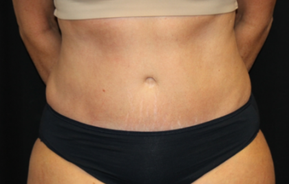 Tummy Tuck Before & After Patient #29819