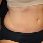 Tummy Tuck Before & After Patient #29819