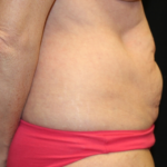 Tummy Tuck Before & After Patient #29819