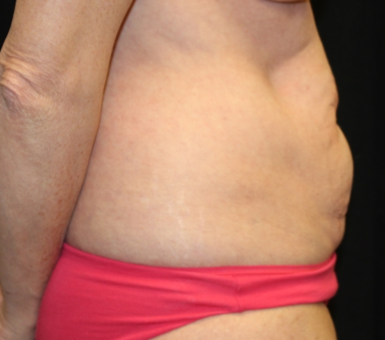 Tummy Tuck Before & After Patient #29819