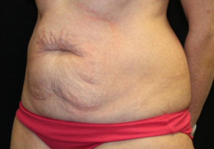 Tummy Tuck Before & After Patient #29819