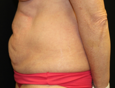 Tummy Tuck Before & After Patient #29819