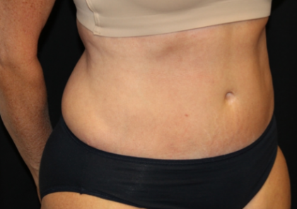 Tummy Tuck Before & After Patient #29819