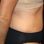 Tummy Tuck Before & After Patient #29819