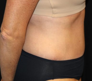 Tummy Tuck Before & After Patient #29819