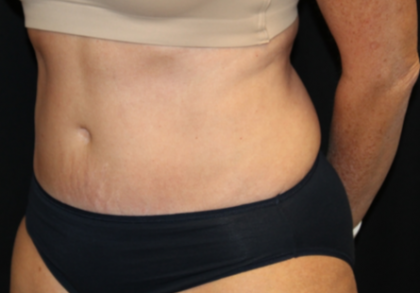 Tummy Tuck Before & After Patient #29819