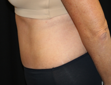 Tummy Tuck Before & After Patient #29819