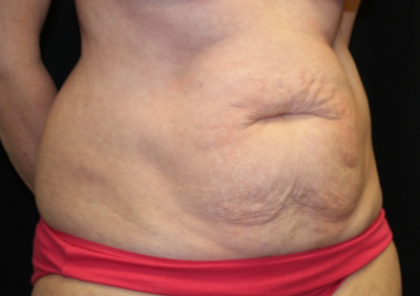 Tummy Tuck Before & After Patient #29819