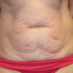 Tummy Tuck Before & After Patient #29819