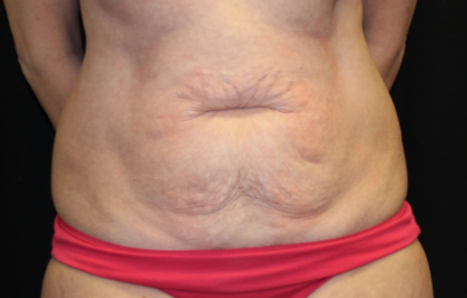 Patient #29819 Tummy Tuck Before and After Photos New Jersey