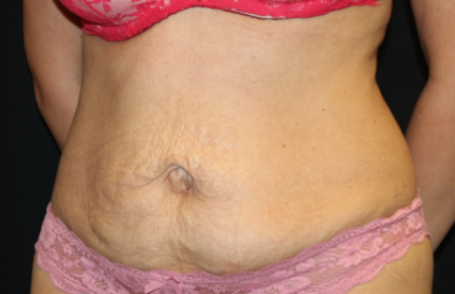 Tummy Tuck Before & After Patient #29841