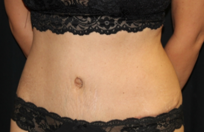 Tummy Tuck Before & After Patient #29841