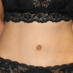 Tummy Tuck Before & After Patient #29841