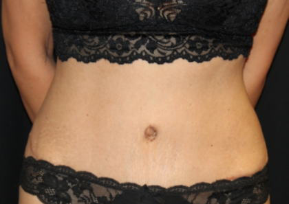 Tummy Tuck Before & After Patient #29841