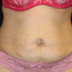 Tummy Tuck Before & After Patient #29841