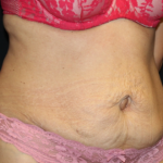 Tummy Tuck Before & After Patient #29841