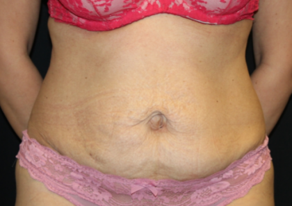 Tummy Tuck Before & After Patient #29841