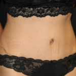 Tummy Tuck Before & After Patient #29841