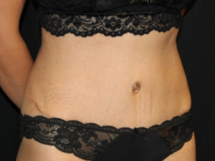 Tummy Tuck Before & After Patient #29841