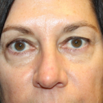 Blepharoplasty Before & After Patient #29832