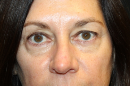 Blepharoplasty Before & After Patient #29832