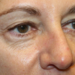 Blepharoplasty Before & After Patient #29832