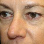 Blepharoplasty Before & After Patient #29832