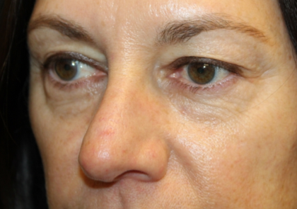 Blepharoplasty Before & After Patient #29832