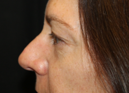 Blepharoplasty Before & After Patient #29832