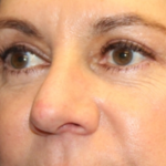 Blepharoplasty Before & After Patient #29832