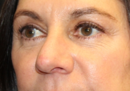 Blepharoplasty Before & After Patient #29832