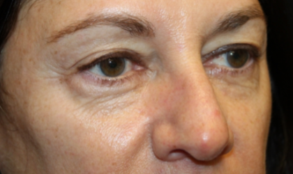 Blepharoplasty Before & After Patient #29832