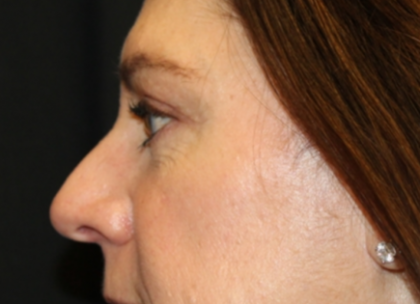 Blepharoplasty Before & After Patient #29832