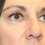 Blepharoplasty Before & After Patient #29832