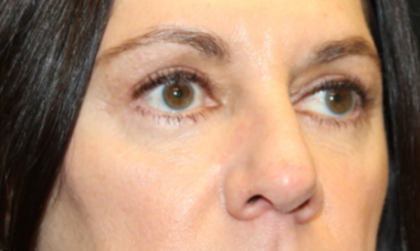 Blepharoplasty Before & After Patient #29832