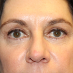 Blepharoplasty Before & After Patient #29832