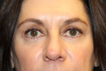 Blepharoplasty Before & After Patient #29832