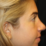 Rhinoplasty Before & After Patient #29808