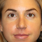 Rhinoplasty Before & After Patient #29808