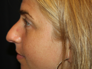 Rhinoplasty Before & After Patient #29808