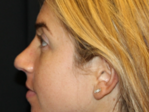 Rhinoplasty Before & After Patient #29808