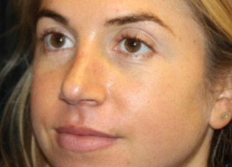 Rhinoplasty Before & After Patient #29808