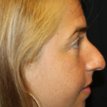 Rhinoplasty Before & After Patient #29808