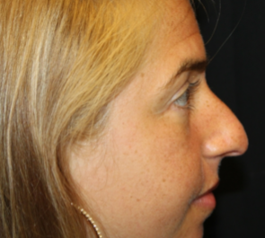 Rhinoplasty Before & After Patient #29808